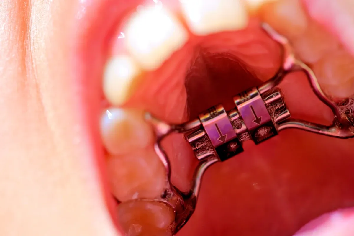 disjoncteur Orthodontiste enfant Strasbourg