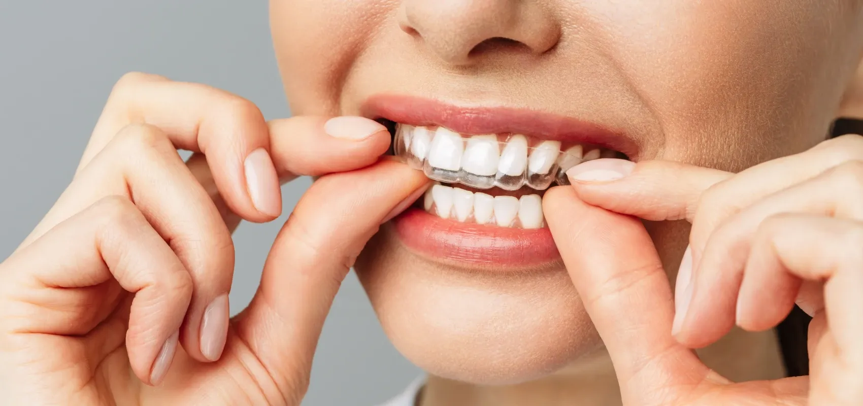 Orthodontiste adulte centre ville Strasbourg